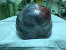 توسط دکتر نوشین مبارکی صورت گرفت : عمل جراحی خارج کردن توده شش کیلویی از شکم خانم ۴۷ ساله اردبیلی